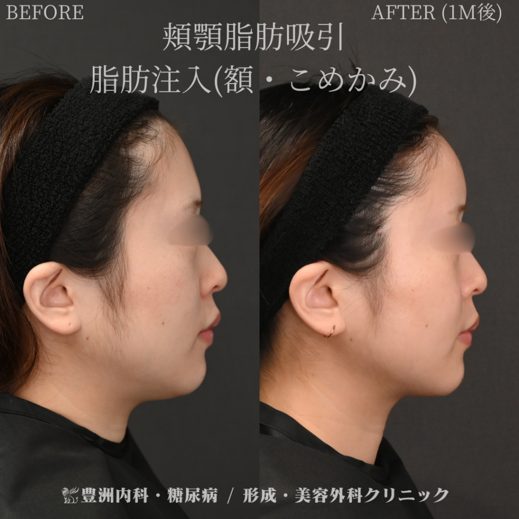 頬顎下脂肪吸引＋額脂肪注入 / 20代女性